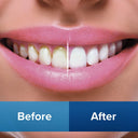 Miracle Smile Water Flosser Complete Kit